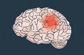 ﻿ ﻿ symptoms of cerebellar strokes are so vague that they can be confused with other illnesses. How To Prevent A Second Stroke Health Essentials From Cleveland Clinic