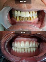 Maybe you would like to learn more about one of these? Before And After All On 6 Snap On Dentures Dental Treatment Dental Dental Ceramics