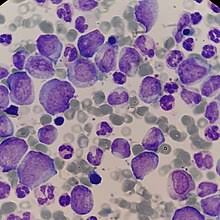 Maybe you would like to learn more about one of these? Leucemia Wikipedia La Enciclopedia Libre