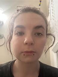 After years of being under my parents care with out proper dental  treatment, I moved out and slowly started the process of correcting my  dental hygiene, before my insurance kicked in I