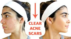 clear acne scars fast diy face masks