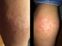 Image result for allergy rash on the legs