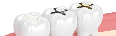 You'll have to wait longer with an amalgam filling (silver) than with a composite filling. How Long Do White Fillings Last Blog