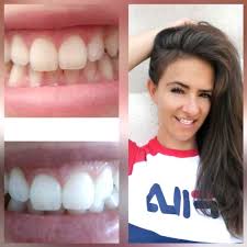 pin auf deine zahnaufhellung