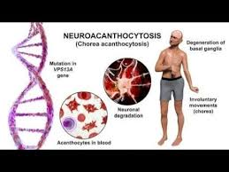 Image result for Chorea