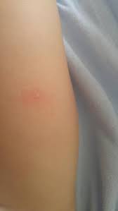 Image result for vyrážka u dětí