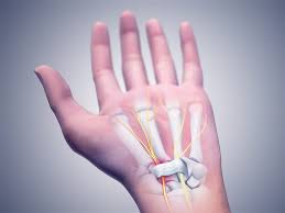 Sinir Sikismasi Nedir Neden Olur Tipleri Doktor Fizik