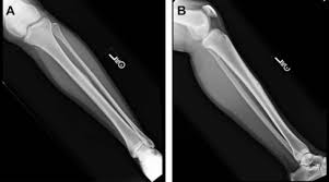 Image result for Tibia Stress Fracture