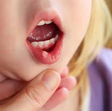 Oleh itu, apabila ada ulser dalam mulut, pastikan anda minum air kosong secukupnya supaya ulser cepat hilang dan mengelakkan ulser baru daripada tumbuh. Ulser Boleh Potong Selera Makan Beri Anak Ubat Penahan Sakit Syrup Paracetamol Pa Ma