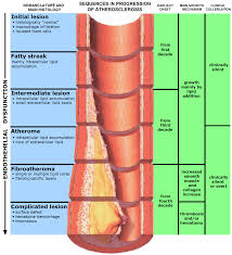 Bodytomy provides a labeled iliac artery diagram to help you understand the anatomy and function of the common iliac. Atherosclerosis Causes Symptoms A Level Biology Notes