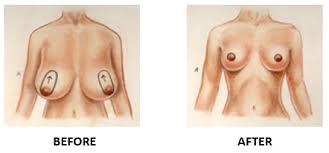 Reshape Your Breasts After Weight Loss | Alberta Plastic Surgery