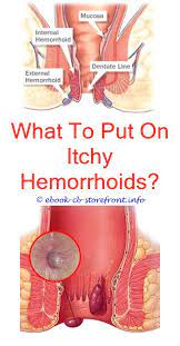 17 Impressive Hemorrhoid Relief It Works Ideas Hemorrhoids Treatment Cure For Hemorrhoids Bleeding Hemorrhoids