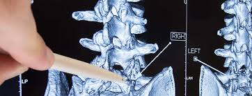 Radiculopathy Johns Hopkins Medicine