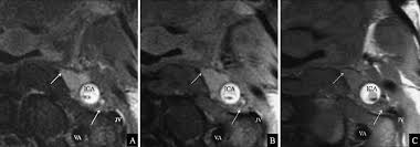 An artery tear, also called a dissection, occurs when layers of the interior arterial walls separate. Periarterial Edema In Spontaneous Carotid Artery Dissection Download Scientific Diagram