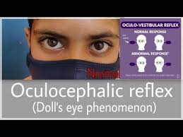 Image result for Oculovestibular Testing