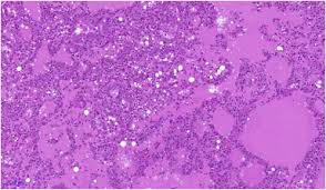 Mucoepidermoid carcinoma is a tumor that usually occurs in the salivary glands. Salivary Gland Tumours Update On Molecular Diagnostics Sciencedirect