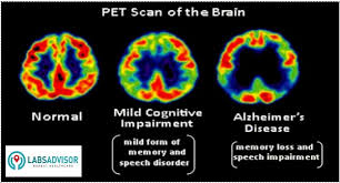 Up To 50 Off On Pet Scan Brain Cost From 9000 Only