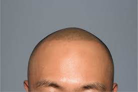 3,179 6 months tattoo products are offered for sale by suppliers on alibaba.com, of which derma rolling there are 1,582 suppliers who sells 6 months tattoo on alibaba.com, mainly located in asia. A Case Of A Shaved Hair Style Scalp Medical Tattoo In A 34 Year Old Download Scientific Diagram
