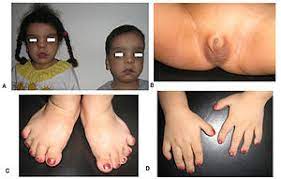 Maybe you would like to learn more about one of these? Robinow Syndrome Wikipedia