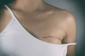 Image result for Mastectomy
