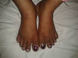 Image result for Clubbing nails feet