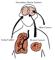 It can happen to anyone at any age, but it's more common in people over age 40. Brain Tumor Cancer Primary Secondary Symptoms Treatment