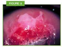I just don't know now how we manage the hpv. Hpv Answering Your Worried Patients S Questions Contemporary Ob Gyn