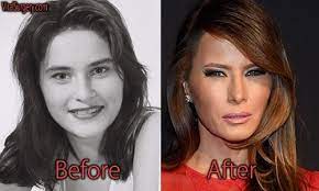 Das traurigste daran ist, dass sie den tumor im anzug neben sich nie entfernen ließ.) before and after surgery photos of melania trump. Pin On Viral Celebrity Plastic Surgeries