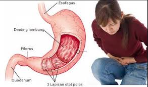 Maybe you would like to learn more about one of these? 8 Ciri Ciri Maag Kronis Dan Akut Rahasia Kesehatan
