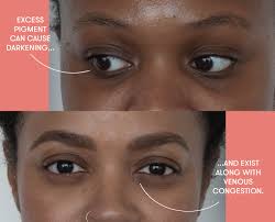 Hostile to oxidant in this oil secure skin and expel polluting influences. Puffy Eyes Dark Circles And Bags Dermatologists Explain The Difference Self