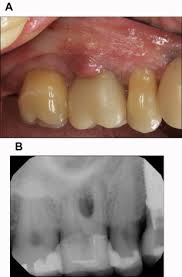 Image result for Periodontal Abscess