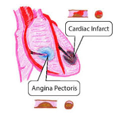 Image result for Angina Pectoris