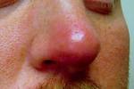 Nostril Ingrown Hair In Nose