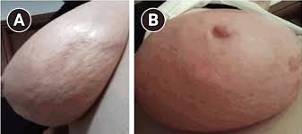 Image result for Inflammatory breast cancer