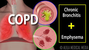 Both chronic bronchitis and emphysema are primarily caused by cigarette smoking.﻿﻿ chronic bronchitis may also be caused by secondhand smoke and air pollution, which irritates the airways and leads to increased inflammation. Copd Chronic Obstructive Pulmonary Disease Animation Youtube