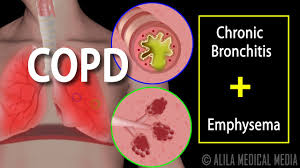 Global initiative for chronic obstructive lung disease (gold) website. Copd Chronic Obstructive Pulmonary Disease Animation Youtube