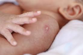 Recommended child and adolescent immunization schedule for ages 18 years or younger, united states, 2021. Bcg Against Coronavirus Less Hype And More Evidence Please