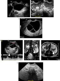 One thing would need to see a lot of times things can happen that ovary on which are simple to follow and even if they. Imaging And Differential Diagnosis Of Ovarian Cancer Sciencedirect