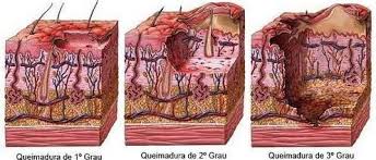 Faça sua pergunta e você receberá respostas de especialistas em perguntas sobre queimaduras. Queimaduras Infomedica Wiki Fandom