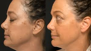 Laser Skin Rejuvenation