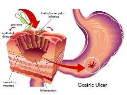 Helicobacter pylori colonizes and grows in human gastric epithelial tissue and mucus. InfecÅ£ia Cu Helicobacter Pylori Cand Este Necesar Tratamentul Cu Antibiotice