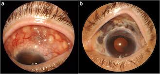 Image result for Scleritis