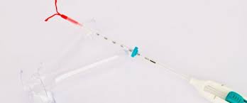 Thingiverse is a universe of things. Innsetting Av Spiral Med Lokal Bedovelse Hos Gynekolog Hos Mjoskirurgene