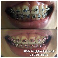 Temukan berbagai jenis perawatan gigi mulai dari scaling (pembersihan gigi), tambal gigi, pasang behel (kawat gigi), veneer, operasi gigi bungsu, whitening (pemutihan gigi). Berita Baik Promosi Braces Klinik Pergigian Shofiyyah Facebook