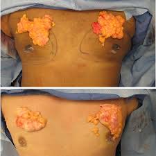 Image result for Gynecomastia
