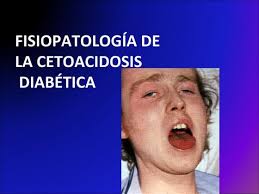 Cetoacidosis diabetica en pediatria