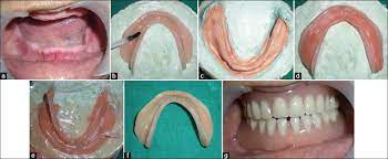 • soft denture liners tend to continually harden, though a patient may not be aware of this happening because the process is gradual. Fabrication And Relining Of Dentures With Permanent Silicone Soft Liner A Novel Way To Increase Retention In Grossly Resorbed Ridge And Minimize Trauma Of Knife Edge And Severe Undercuts Ridges Singh K