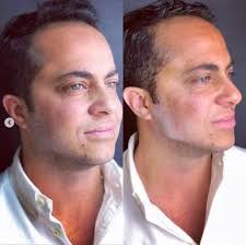 Bichectomia , antes e depois. Pin Em Antes E Depois Da Harmonizacao Facial