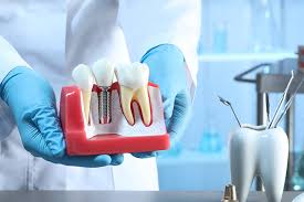 Choosing Dental Implants: The Ultimate Guide to a Beautiful Smile