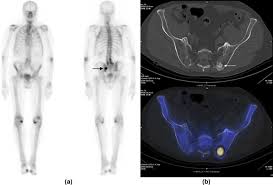 Protocol Driven Multidetector Spect Ct Integration Of Hybrid Imaging Into The Routine Workflow Of Whole Body Bone Scintigraphy In Oncology Patients Clinical Radiology